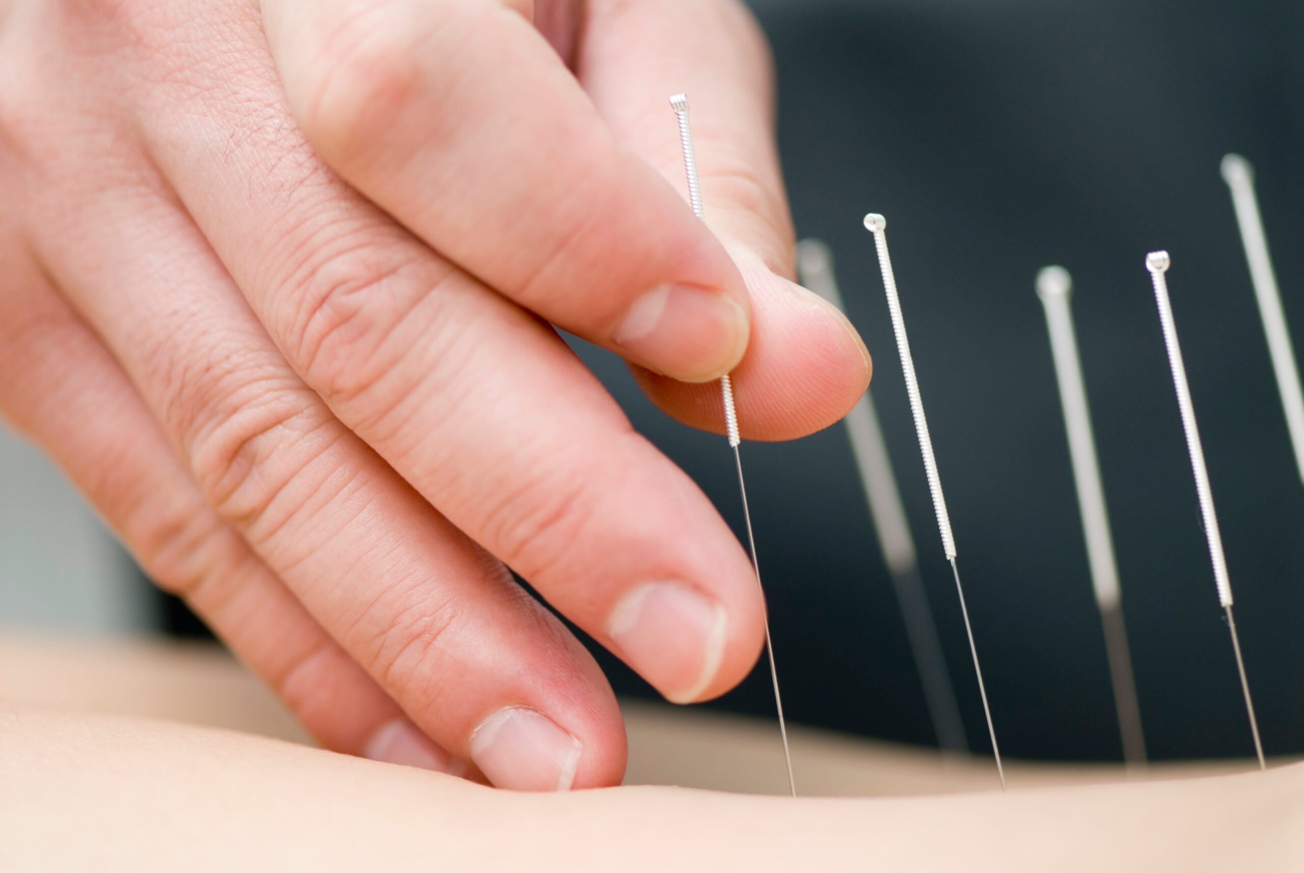A person receiving acupuncture treatment for back pain.
